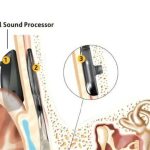 अभिनव कानाची शस्त्रक्रिया 23 वर्षांच्या वृद्धाला एकतर्फी बहिरेपणापासून बरे होण्यास मदत करते
