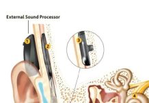 अभिनव कानाची शस्त्रक्रिया 23 वर्षांच्या वृद्धाला एकतर्फी बहिरेपणापासून बरे होण्यास मदत करते
